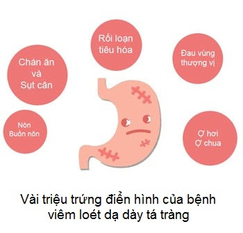 triệu chứng điển hình của viêm loét dạ dày tá tràng