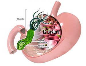viêm dạ dày là bệnh gì