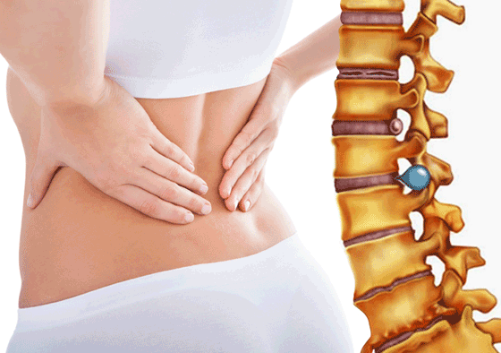 thoát vị đĩa đệm