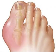 bệnh gout - thống phong