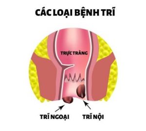 các loại bệnh trĩ