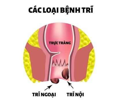 các loại bệnh trĩ