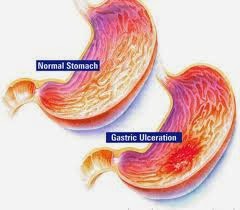 dấu hiệu bệnh viêm dạ dày