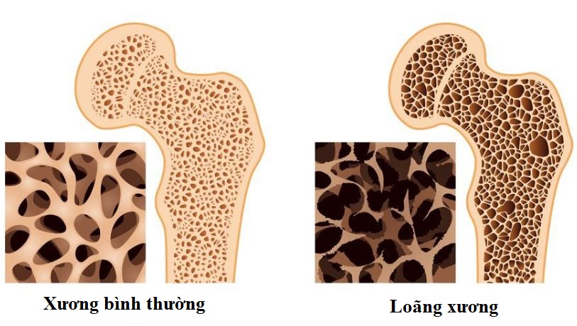 loãng xương