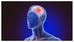 Kinh nghiệm phục hồi di chứng tai biến mạch máu não