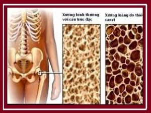 thiếu canxi gây ảnh hưởng nặng nề lên xương