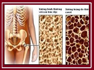 thiếu canxi gây ảnh hưởng nặng nề lên xương