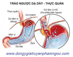chữa trào ngược - ợ chua