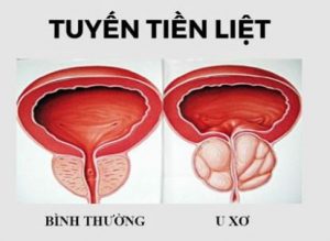 u phì đại tuyến tiền liệt