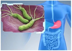 vi khuẩn HP không đồng nghĩa với viêm dạ dày