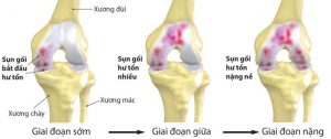 trị bệnh thoái hóa khớp
