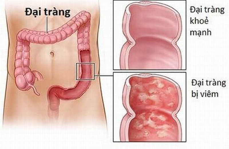 Triệu chứng viêm đại tràng