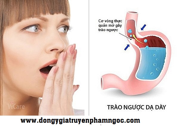 Trào ngược dạ dày