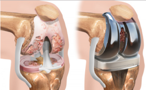 5 phương pháp chữa bệnh thoái hoá xương khớp tốt nhất